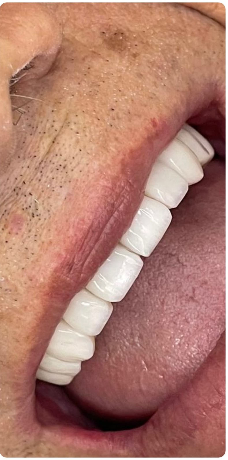 Depois do tratamento de Facetas em resina