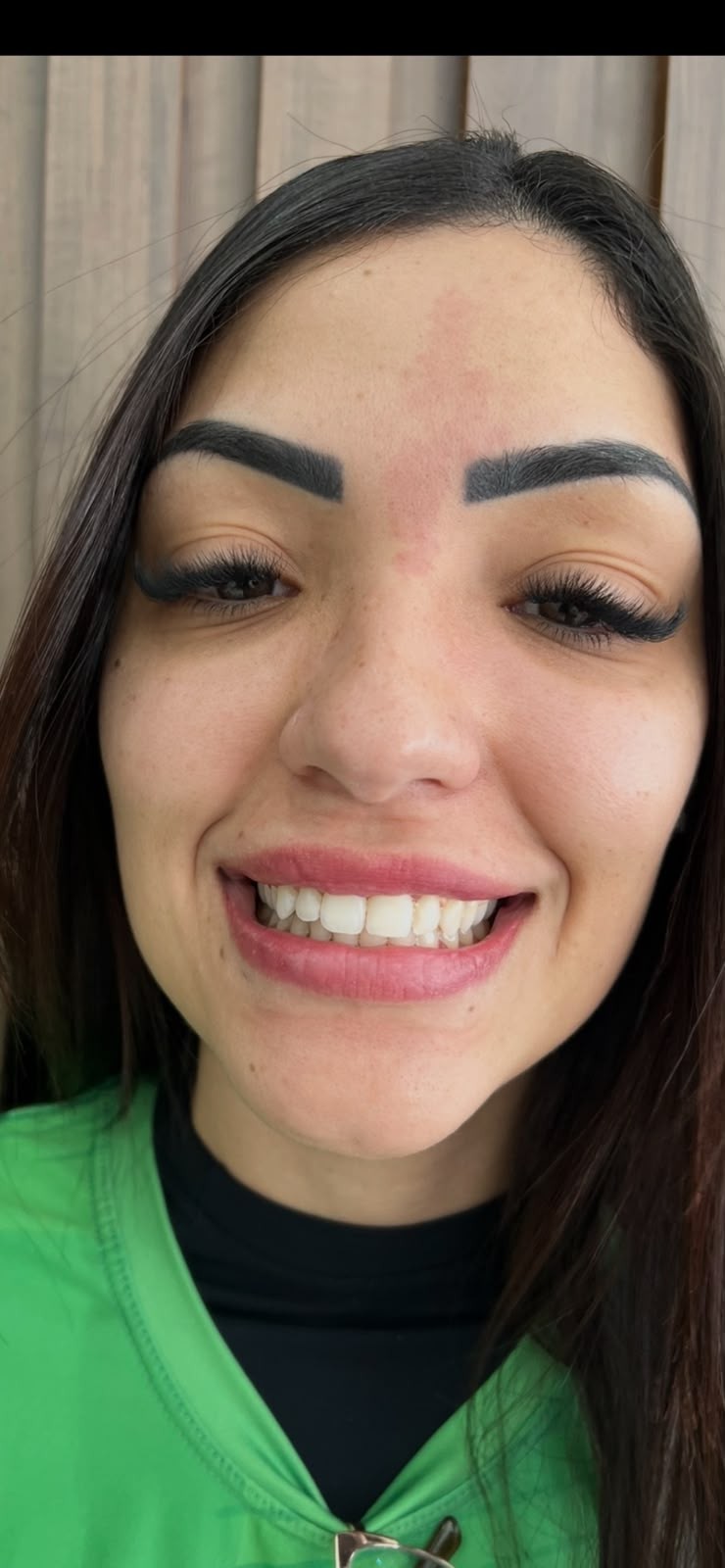 Depois do tratamento de Clareamento dental