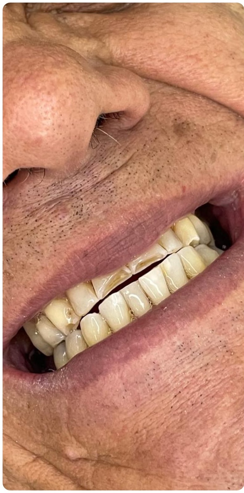 Antes do tratamento de Facetas em resina