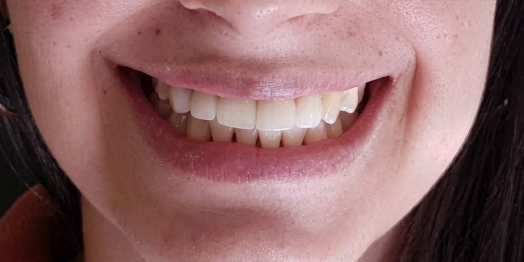 Depois do tratamento de Implantes dentários